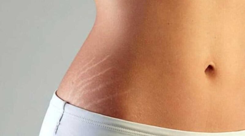 Top Tips for Preventing and Reducing the Appearance of Stretch Marks
